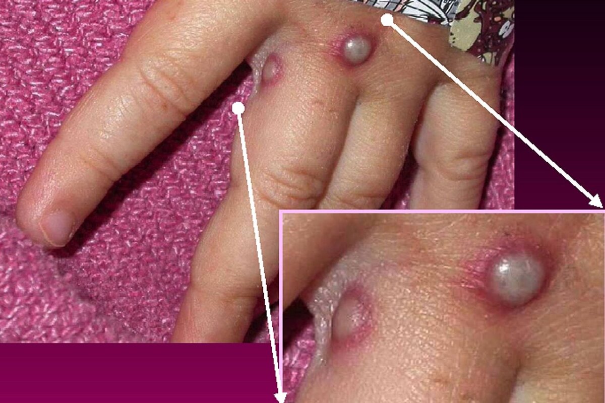 آبله میمونی مقابله‌ای در برابر تهدیدات جنگ‌های بیولوژیک در شرایط کنونی دنیا است
