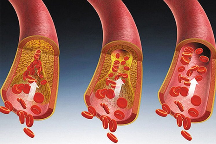 بهترین راه کاهش چربی خون