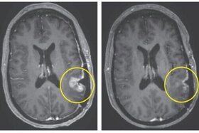 یک درمان جدید تومور مغزی را در عرض تنها ۵ روز از بین برد