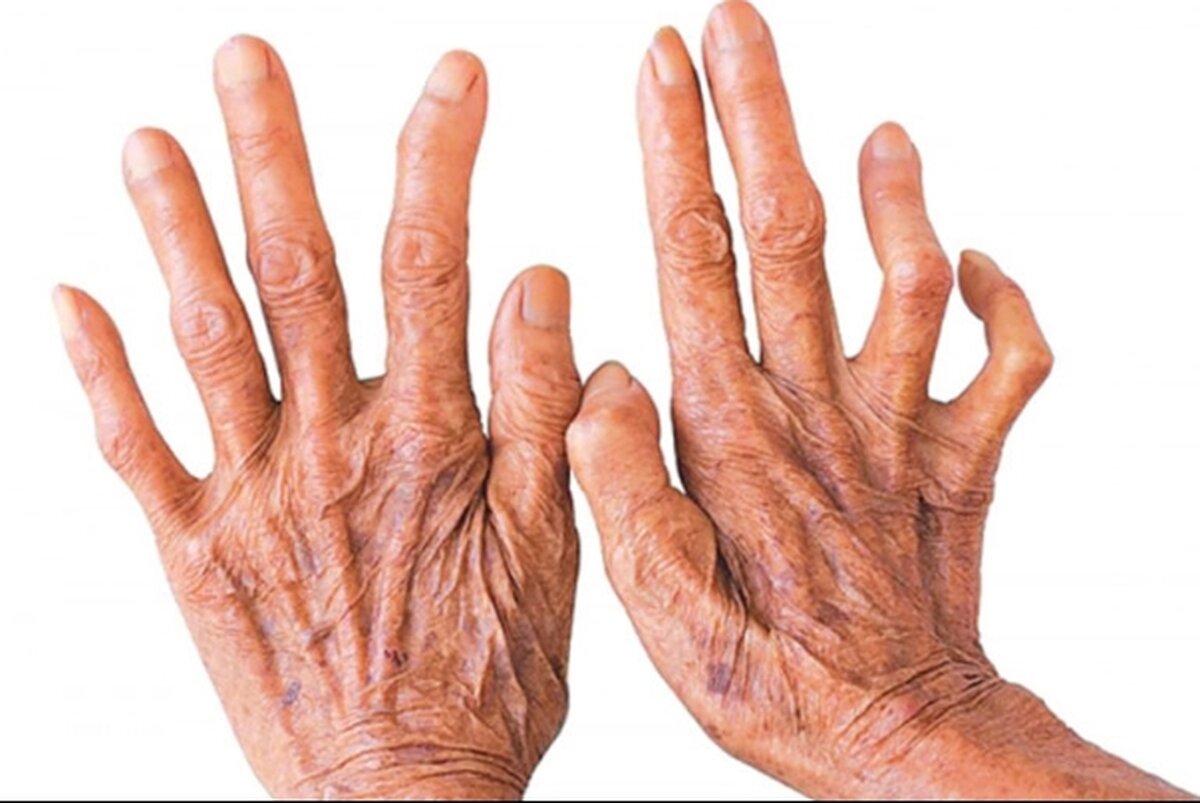 جذام قابل درمان است / آمار ابتلا در جهان و ایران