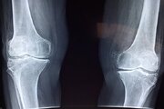 تشخیص علائم اولیه پوکی استخوان با هوش مصنوعی