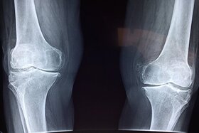 تشخیص علائم اولیه پوکی استخوان با هوش مصنوعی